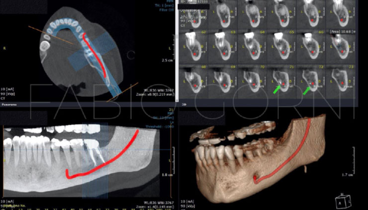 A complex mandibular second molar : a particular clinical case - Publications